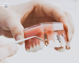 Los implantes dentales son la mejor opción para reponer piezas dentales perdidas
