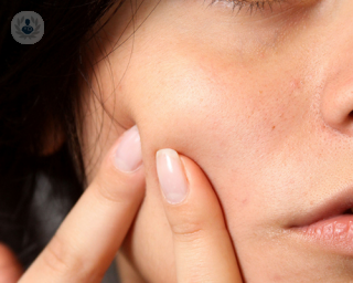 Dudas del acné por una dermatóloga | Top Doctors