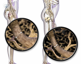 osteoporosis factores riesgo tratamiento
