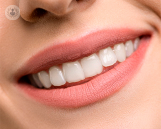 Las carillas son láminas que se ponen por encima de los dientes más visibles del rostro
