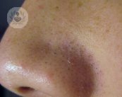 Este artículo explica qué es y como se trata tanto el acné juvenil como el tardío.