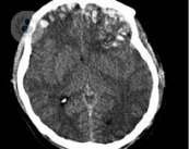 El daño cereral adquirido comporta un complejo proceso de rehabilitación cognitiva. Rehabilitación neuropsicológica es la más frecuente.