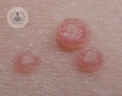 El molusco contagioso o molluscum, es una infección de la piel que se manifiesta principalmente por la aparición de granitos en la piel y es contagioso.
