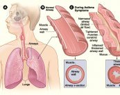pulmones asma