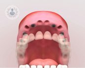 ¿Tienes dudas sobre los implantes dentales? El Dr. Salgado, experto en Odontología y Estomatología responde a algunas cuestiones sobre el tema