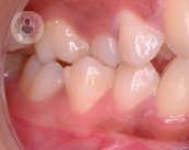 maloclusion dental tratamiento
