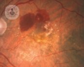 La degeneración macular es una enfermedad que produce lesiones en la retina. El Dr. Gallego te informa 