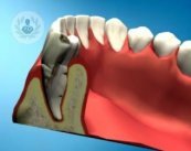 Los implantes dentales de carga inmediata se colocan en las primeras 72 horas tras la cirugía. El Dr. Salgado informa. 