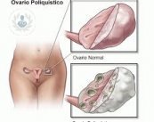 Sindrome del ovario poliquistico