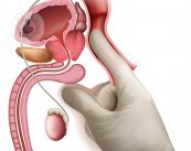 La hiperplasia o hipertrofia benigna de próstata ocurre por estímulo de la testosterona en la glándula prostática