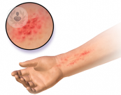 La dermatitis atópica es un trastorno que se traduce en erupciones rojas y picor en la piel