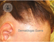 Alopecia frontal fibrosante