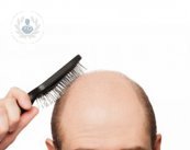 injerto capilar para alopecia