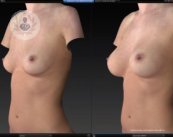 Descubre todos los detalles sobre los simuladores 3D para un aumento de senos.