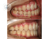 La cirugía ortognática tiene dos objetivos: mejorar la armonía y estética faciales y una buena oclusión dental.