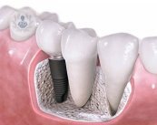 implante dental complicaciones