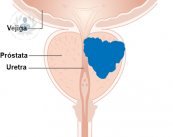cancer prostata pronostico