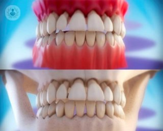 La periodontitis es una enfermedad que afecta a las encías.