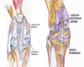 tratamiento de la artrosis de rodilla