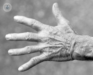 terapias biológicas para frenar el avance de la artritis reumatoide