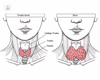 bocio multinodular glandula tiroides