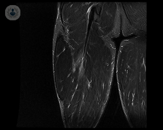 radiografia rotura fibrilar biceps femoral