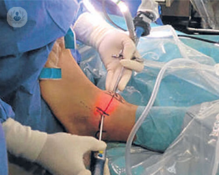 Cirugía laparoscópica para la inestabilidad crónica del tobillo