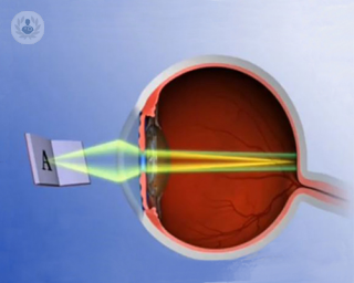 cómo funcionan las lentes intraoculares multifocales