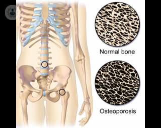 hueso con osteoporosis
