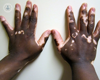 vitiligo en las manos