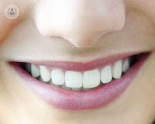 El blanqueamiento dental permite reducir varios tonos el color del diente