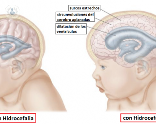 La hidrocefalia es una acumulación de líquido en el cerebro