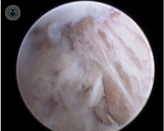 Una artroscopia es una técnica quirúrgica mediante la que se introduce una cámara muy pequeña en una articulación para ver con detalle su interior. 