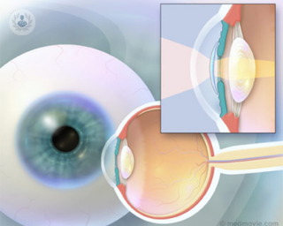 caracteristicas lentes intraoculares