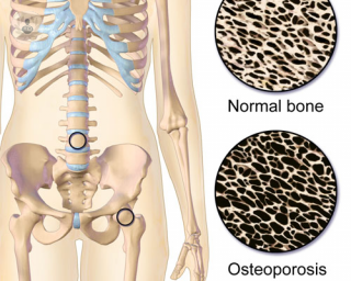 La osteoporosis puede ser primaria (por falta de estrógenos o por edad) o secundaria (consecuencia de un fármaco o enfermedad)