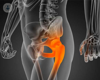 ¿Cómo influye padecer artrosis de cadera en la vida sexual de la persona que lo sufre? Entérate en este artículo.