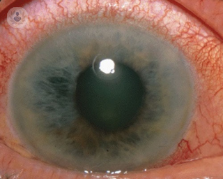 El glaucoma es una enfermedad que puede llegar a provocar ceguera