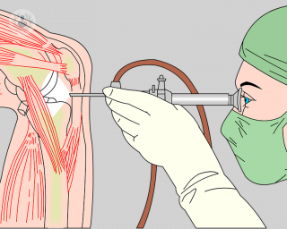 La artroscopia permite analizar la articulación, hacer limpieza, extirpaciones o distintas intervenciones quirúrgicas.