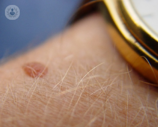 El número de pacientes con melanomas se multiplica por tres cada cinco años