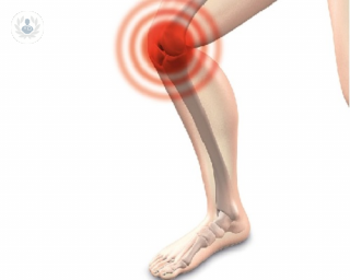 La artroplastia de rodilla permite reemplazar la articulación de la rodilla por una articulación artificial gracias a una prótesis.
