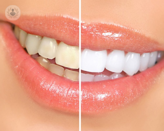 Los dientes pueden oscurecerse debido al tabaco u otras causas. Existe una gran variedad de técnicas para limpiar las manchas y conseguir unos dientes más blancos.