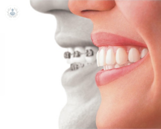Ortodoncia invisble: comodidad y estética