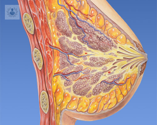 Prótesis de implantes mamarios con forma anatómica