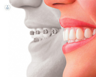 tratamiento ortodoncia transparente: Invisalign
