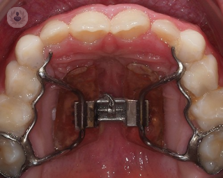La expansión del paladar: una técnica ortodóntica que crea espacio y alinea los dientes para una sonrisa saludable y armoniosa