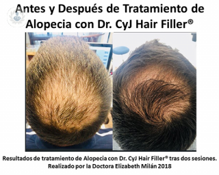 tratamiento revolucionario para la caida del cabello