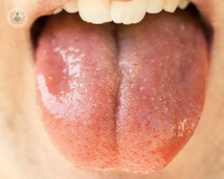 sindrome boca ardiente tratamientos sintomas