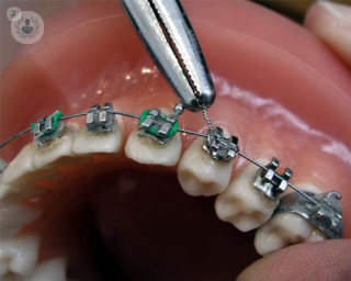 Colocación de brackets ortodoncia