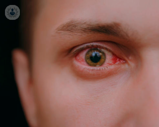 ojo con conjuntivitis