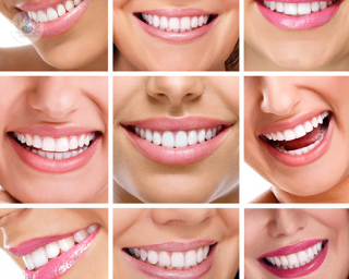 blanqueamiento_dental_estetica_dental_sonrisa